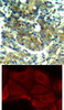 <b>Top Image:</b> Immunohistochemical analysis of paraffin-embedded human breast carcinoma tissue using p70 S6 Kinase (Phospho-Ser411) .<b>Bottom Image:</b> Immunofluorescence staining of methanol-fixed MCF7 cells using p70 S6 Kinase (Phospho-Ser411) .