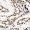Immunohistochemical analysis of paraffin-embedded human breast carcinoma tissue using CREB (Phospho-Ser129) .