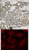 <b>Top Image:</b> Immunohistochemical analysis of paraffin-embedded human breast carcinoma tissue using p56Dok-2 (Phospho-Tyr299) .<b>Bottom Image:</b> Immunofluorescence staining of methanol-fixed HeLa cells using p56Dok-2 (Phospho-Tyr299) .