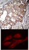 <b>Top Image:</b> Immunohistochemical analysis of paraffin-embedded human breast carcinoma tissue using Shc1 (Phospho-Tyr427) .<b>Bottom Image:</b> Immunofluorescence staining of methanol-fixed HeLa cells using Shc1 (Phospho-Tyr427) .