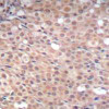 Immunohistochemical analysis of paraffin-embedded human breast carcinoma tissue using Smad3 (Phospho-Ser425) .