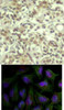 <b>Top Image:</b> Immunohistochemical analysis of paraffin-embedded human breast carcinoma tissue using AKT1 (Phospho-Thr450) .<b>Bottom Image:</b> Immunofluorescence staining of methanol-fixed HeLa cells using AKT1 (phospho-Thr450) .