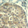 Immunohistochemical analysis of paraffin-embedded human breast carcinoma tissue using cofilin1/cofilin2 (Phospho-Tyr88) .