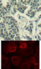 <b>Top Image:</b> Immunohistochemical analysis of paraffin-embedded human breast carcinoma tissue using Her3/ErbB3 (Phospho-Tyr1328) .<b>Bottom Image:</b> Immunofluorescence staining of methanol-fixed MCF7 cells using Her3/ErbB3 (phospho-Tyr1328) .