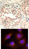 <b>Top Image:</b> Immunohistochemical analysis of paraffin-embedded human breast carcinoma tissue using CDK6 (Phospho-Tyr13) .<b>Bottom Image:</b> Immunofluorescence staining of methanol-fixed HeLa cells using CDK6 (phospho-Tyr13) .