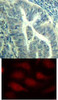 <b>Top Image:</b> Immunohistochemical analysis of paraffin-embedded human colon carcinoma tissue using CDK6 (Phospho-Tyr24) .<b>Bottom Image:</b> Immunofluorescence staining of methanol-fixed HeLa cells using CDK6 (phospho-Tyr24) .