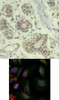 <b>Top Image:</b> Immunohistochemical analysis of paraffin-embedded human breast carcinoma tissue using MDM2 (Phospho-Ser166) .<b>Bottom Image:</b> Immunofluorescence staining of methanol-fixed HeLa cells using MDM2 (phospho-Ser166) .