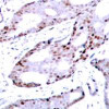 Immunohistochemical analysis of paraffin-embedded human breast carcinoma tissue using c-Jun (Ab-73) .