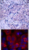 <b>Top Image:</b> Immunohistochemical analysis of paraffin-embedded human breast carcinoma tissue using PDK1 (Ab-241) .<b>Bottom Image:</b> Immunofluorescence staining of methanol-fixed MCF7 cells using PDK1 (Ab-241) .