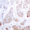 Immunohistochemical analysis of paraffin-embedded human breast carcinoma tissue using Raf1 (Ab-259) .
