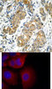 <b>Top Image:</b> Immunohistochemical analysis of paraffin-embedded human breast carcinoma tissue using GSK3&#945; (Ab-21) .<b>Bottom Image:</b> Immunofluorescence staining of methanol-fixed MCF7 cells using GSK3&#945; (Ab-21) .