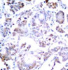 Immunohistochemical analysis of paraffin-embedded human breast carcinoma tissue using NF&#954;B-p65 (Ab-254) .