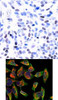 <b>Top Image:</b> Immunohistochemical analysis of paraffin-embedded human breast carcinoma tissue using NF&#954;B-p100/p52 (Ab-866) .<b>Bottom Image:</b> Immunofluorescence staining of methanol-fixed HeLa cells using NF&#954;B-p100/p52 (Ab-866) .