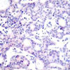 Immunohistochemical analysis of paraffin-embedded human breast carcinoma tissue using NF&#954;B-p105/p50 (Ab-893) .