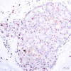 Immunohistochemical analysis of paraffin-embedded human breast carcinoma tissue using NF&#954;B-p105/p50 (Ab-907) .