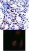 <b>Top Image:</b> Immunohistochemical analysis of paraffin-embedded human breast carcinoma tissue using c-Jun (Ab-91) .<b>Bottom Image:</b> Immunofluorescence staining of methanol-fixed HeLa cells using c-Jun (Ab-91) .