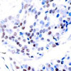 Immunohistochemical analysis of paraffin-embedded human breast carcinoma tissue using c-Jun (Ab-239) .
