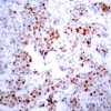 Immunohistochemical analysis of paraffin-embedded human breast carcinoma tissue using ATF2 (Ab-69 or 51) .