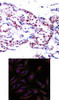 <b>Top Image:</b> Immunohistochemical analysis of paraffin-embedded human breast carcinoma tissue using ATF2 (Ab-71 or 53) .<b>Bottom Image:</b> Immunofluorescence staining of methanol-fixed HeLa cells using ATF2 (Ab-71 or 53) .
