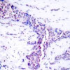 Immunohistochemical analysis of paraffin-embedded human breast carcinoma tissue using ATF2 (Ab-73 or 55) .