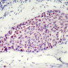 Immunohistochemical analysis of paraffin-embedded human breast carcinoma tissue using ATF2 (Ab-112 or 94) .