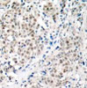 Immunohistochemical analysis of paraffin-embedded human breast carcinoma tissue using Myc (Ab-358) .