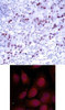 <b>Top Image:</b> Immunohistochemical analysis of paraffin-embedded human breast carcinoma tissue using GATA1 (Ab-142) .<b>Bottom Image:</b> Immunofluorescence staining of methanol-fixed HeLa cells using GATA1 (Ab-142) .