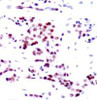 Immunohistochemical analysis of paraffin-embedded human breast carcinoma tissue using STAT5A (Ab-780) .