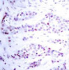 Immunohistochemical analysis of paraffin-embedded human breast carcinoma tissue using STAT6 (Ab-641) .