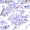 Immunohistochemical analysis of paraffin-embedded human breast carcinoma tissue using STAT6 (Ab-645) .