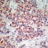 Immunohistochemical analysis of paraffin-embedded human breast carcinoma tissue using PTEN (Ab-370) .