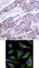 <b>Top Image:</b> Immunohistochemical analysis of paraffin-embedded human breast carcinoma tissue using BCL-2 (Ab-56) .<b>Bottom Image:</b> Immunofluorescence staining of methanol-fixed HeLa cells using BCL-2 (Ab-56) .
