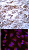 <b>Top Image:</b> Immunohistochemical analysis of paraffin-embedded human breast carcinoma tissue using BCL-2 (Ab-70) .<b>Bottom Image:</b> Immunofluorescence staining of methanol-fixed HeLa cells using BCL-2 (Ab-70) .