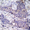 Immunohistochemical analysis of paraffin-embedded human breast carcinoma tissue using BAD (Ab-136) .