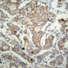 Immunohistochemical analysis of paraffin-embedded human breast carcinoma tissue using BAD (Ab-155) .