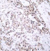 Immunohistochemical analysis of paraffin-embedded human breast carcinoma tissue using Estrogen Receptor-&#945; (Ab-106) .