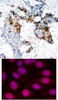 <b>Top Image:</b> Immunohistochemical analysis of paraffin-embedded human breast carcinoma tissue using Estrogen Receptor-&#945; (Ab-118) .<b>Bottom Image:</b> Immunofluorescence staining of methanol-fixed MCF cells using Estrogen Receptor-&#945; (Ab-118) .