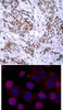 <b>Top Image:</b> Immunohistochemical analysis of paraffin-embedded human breast carcinoma tissue using Estrogen Receptor-&#945; (Ab-167) .<b>Bottom Image:</b> Immunofluorescence staining of methanol-fixed MCF cells using Estrogen Receptor-&#945; (Ab-167) .