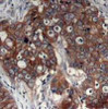 Immunohistochemical analysis of paraffin-embedded human breast carcinoma tissue using HER2 (Ab-877) .