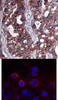 <b>Top Image:</b> Immunohistochemical analysis of paraffin-embedded human breast carcinoma tissue using HER2 (Ab-1221/1222) .<b>Bottom Image:</b> Immunofluorescence staining of methanol-fixed MCF cells using HER2 (Ab-1221/1222) .