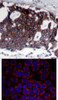 <b>Top Image:</b> Immunohistochemical analysis of paraffin-embedded human breast carcinoma tissue using HER2 (Ab-1248) .<b>Bottom Image:</b> Immunofluorescence staining of methanol-fixed MCF7 cells using HER2 (Ab-1248) .