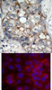 <b>Top Image:</b> Immunohistochemical analysis of paraffin-embedded human breast carcinoma tissue using EGFR (Ab-1070) .<b>Bottom Image:</b> Immunofluorescence staining of methanol-fixed MCF cells using EGFR (Ab-1070) .