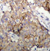 Immunohistochemical analysis of paraffin-embedded human breast carcinoma tissue using EGFR (Ab-1092) .