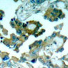 Immunohistochemical analysis of paraffin-embedded human lung carcinoma tissue using FAK (Ab-861) .