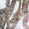 Immunohistochemical analysis of paraffin-embedded human breast carcinoma tissue using Integrin &#946;3 (Ab-773) .