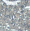 Immunohistochemical analysis of paraffin-embedded human breast carcinoma tissue using Paxillin (Ab-118) .