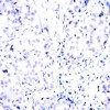 Immunohistochemical analysis of paraffin-embedded human breast carcinoma tissue using Rb (Ab-807) .