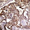 Immunohistochemical analysis of paraffin-embedded human breast carcinoma tissue using SEK1/MKK4 (Ab-80) .