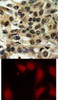 <b>Top Image:</b> Immunohistochemical analysis of paraffin-embedded human breast carcinoma tissue using cdc25C (Ab-216) .<b>Bottom Image:</b> Immunofluorescence staining of methanol-fixed HeLa cells using cdc25C (Ab-216) .