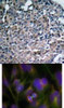 <b>Top Image:</b> Immunohistochemical analysis of paraffin-embedded human breast carcinoma tissue using FAK (Ab-925) .<b>Bottom Image:</b> Immunofluorescence staining of methanol-fixed HeLa cells using FAK (Ab-925) .